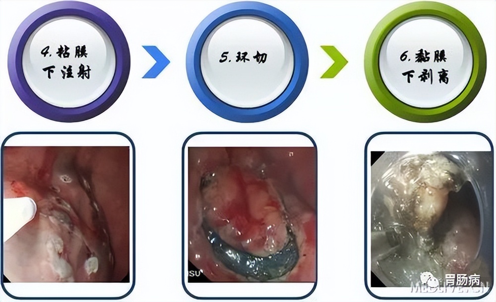 esd内镜下粘膜剥离几天可愈合,内镜下粘膜剥离术属于esd还是emr