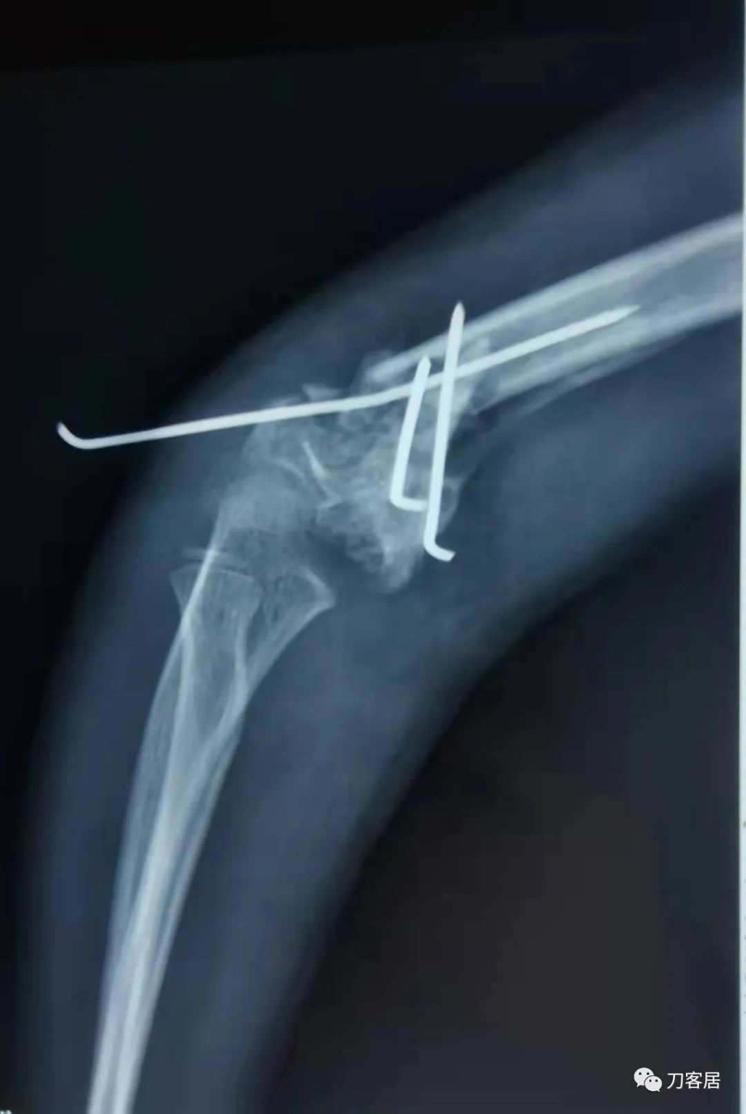 孩子胳膊摔伤肿了不能弯曲一直疼,9岁男孩摔倒手臂痛怎么办