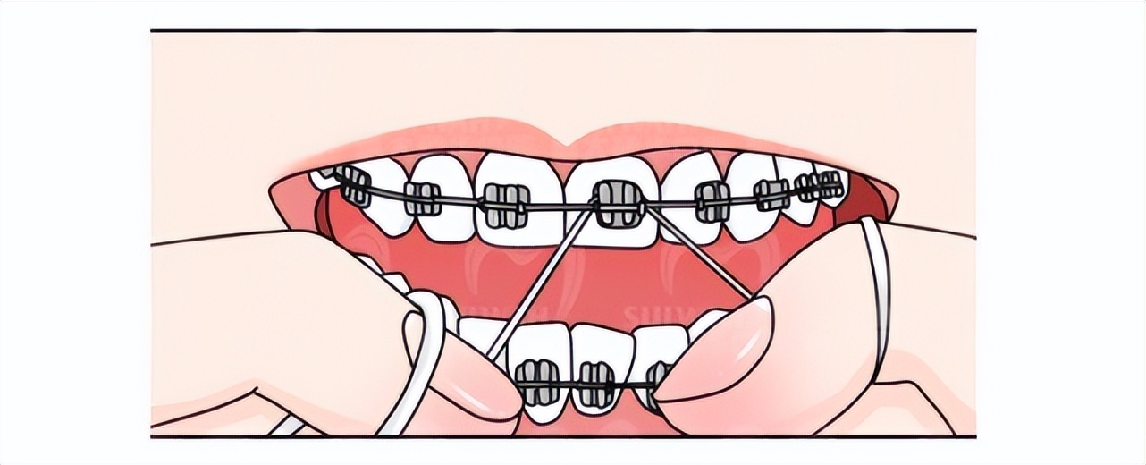 金属自锁托槽经常口腔溃疡怎么办,戴托槽要怎么防止口腔溃疡