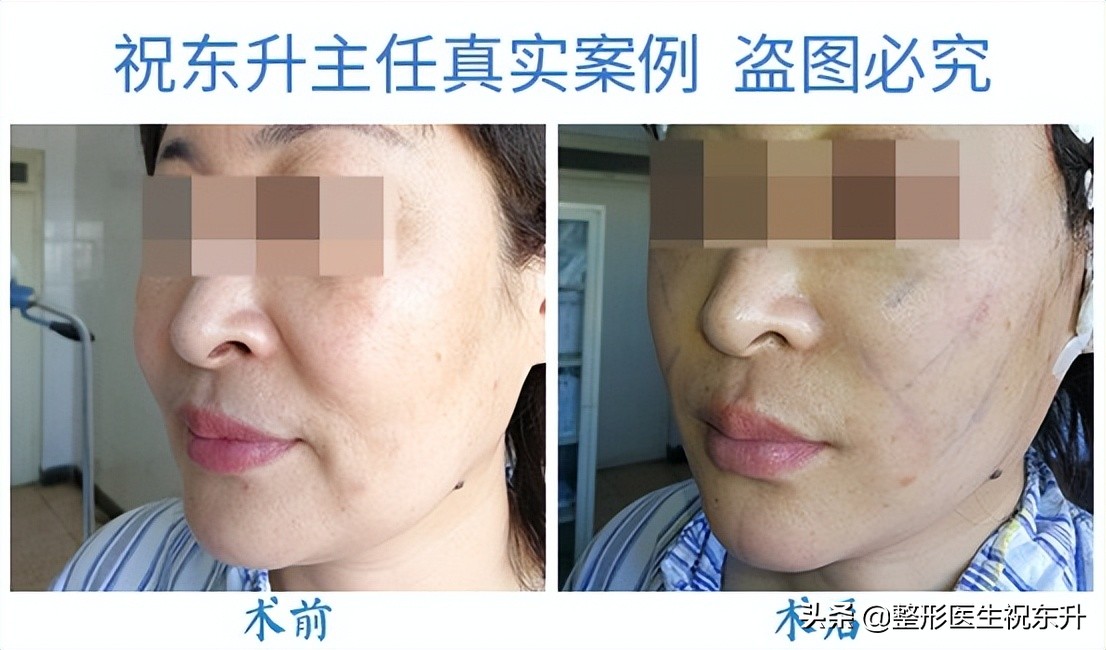 口角纹和法令纹去除方法,法令纹嘴角纹去除最好的方法