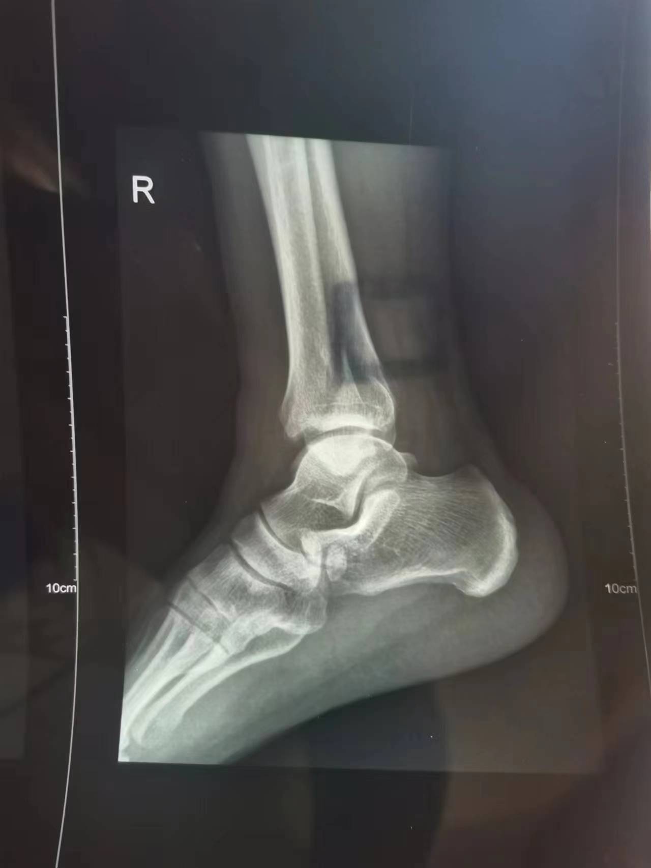 脚踝上侧骨折手术的全过程,脚踝骨折手术费用多少