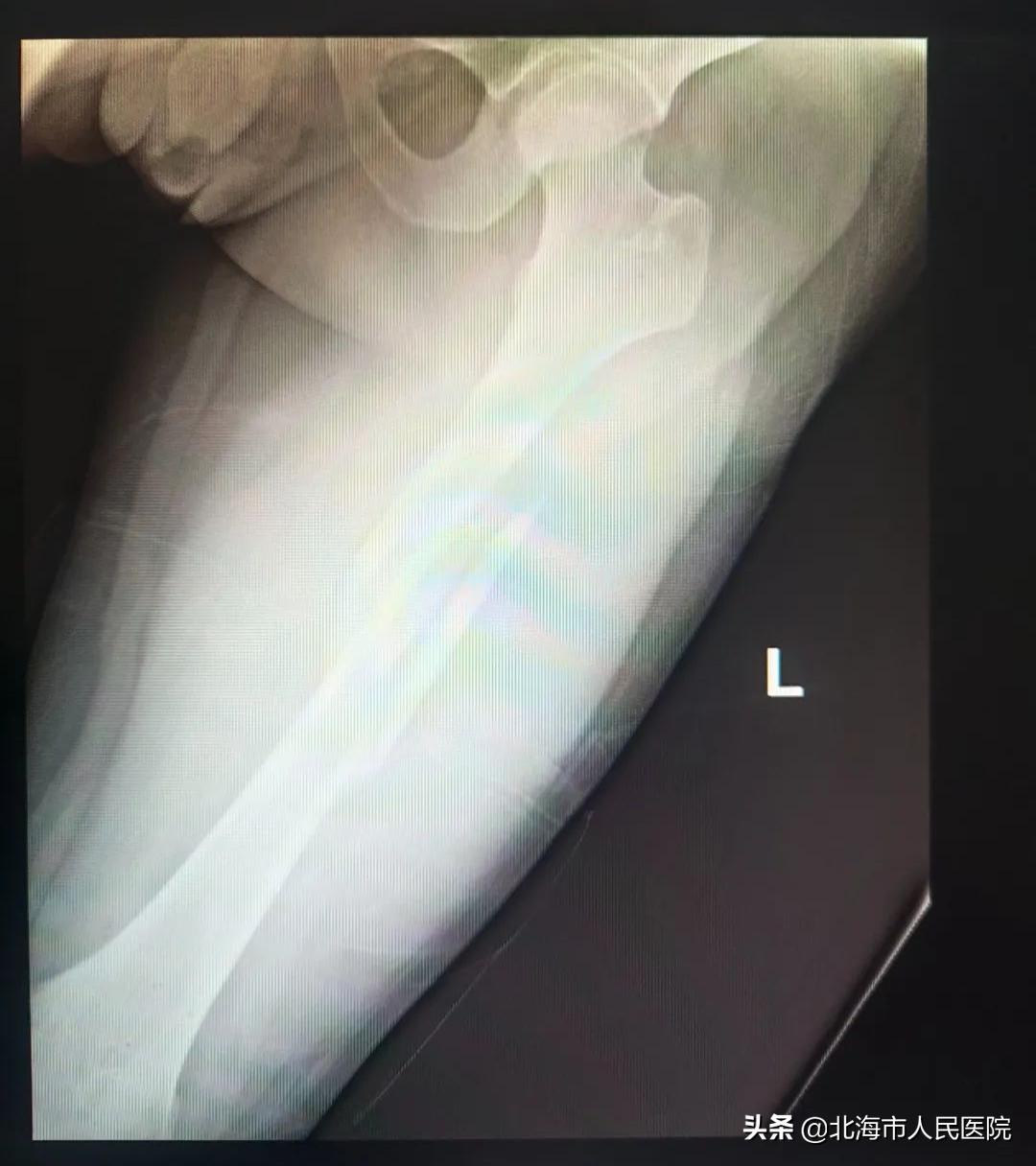 男子足球撞门柱,男子踢球被断球摔倒骨折