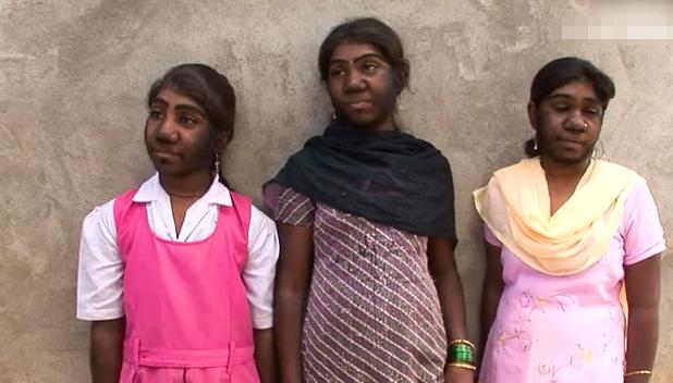 故事:非洲17岁女孩长满络腮胡,毛发从鼻孔长到脖子,身体有何异常