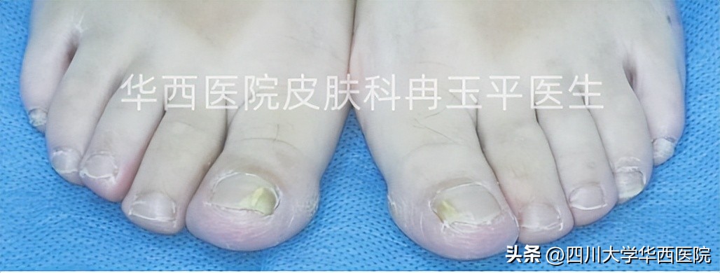 得了灰指甲是指甲变灰吗,灰指甲增厚变黑是灰指甲吗