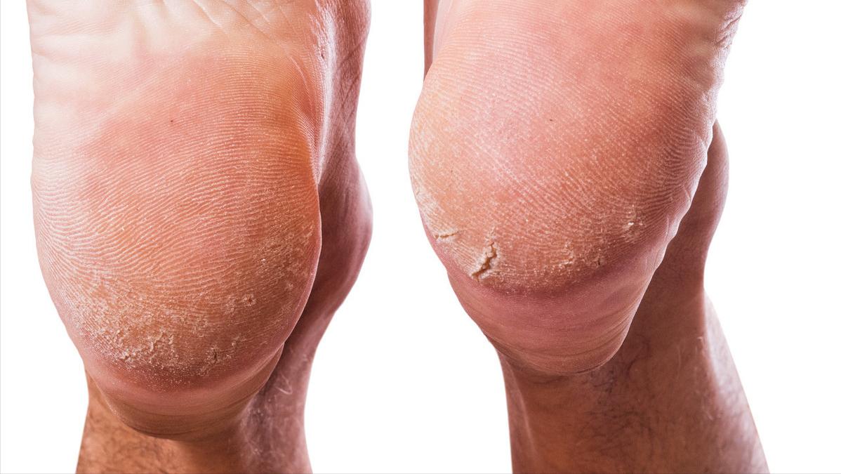 脚后跟干裂一般都是什么原因,脚后跟严重干裂是什么原因导致的