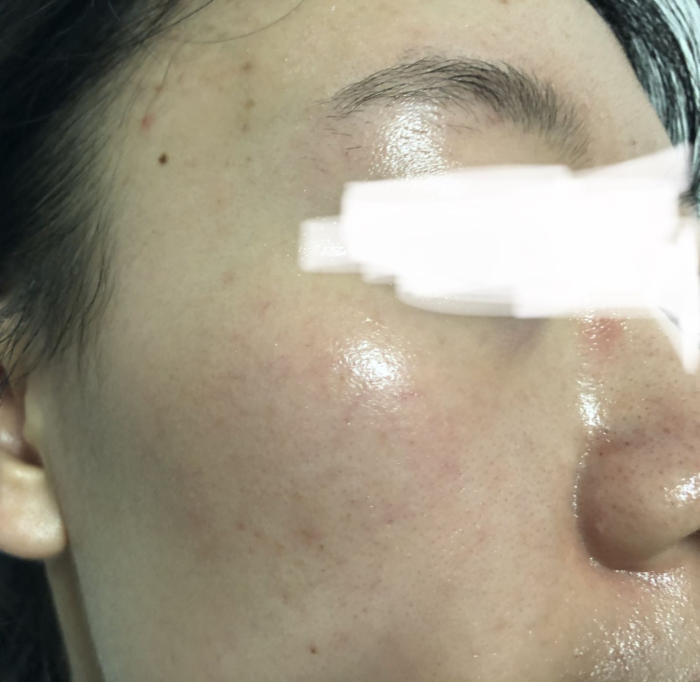 额头眉心发红有闭口粉刺,眉心鼻头频繁起粉刺怎么办