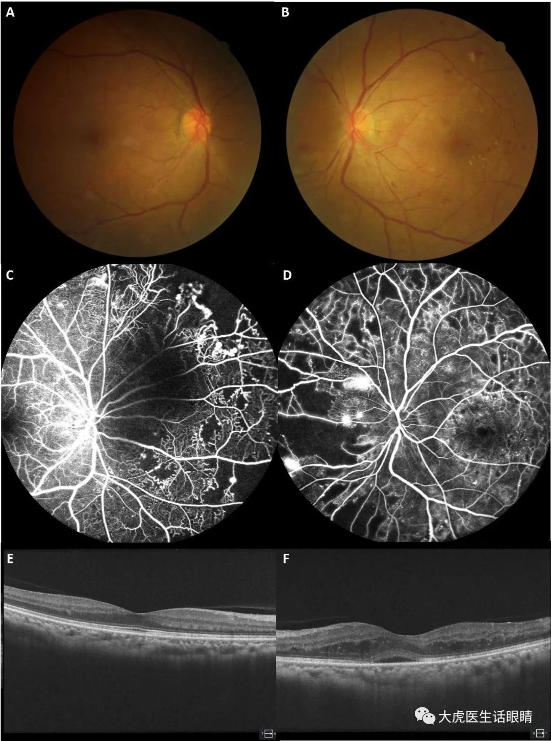 放射性视神经病变,放射性脑炎影像表现
