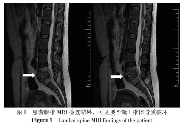 取环术后感染严重的案例,取环感染的症状有哪些