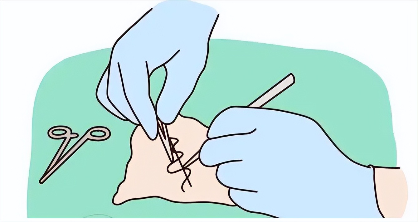 顺产侧切和剖腹产哪个危险,顺产侧切和剖腹产哪个危害大