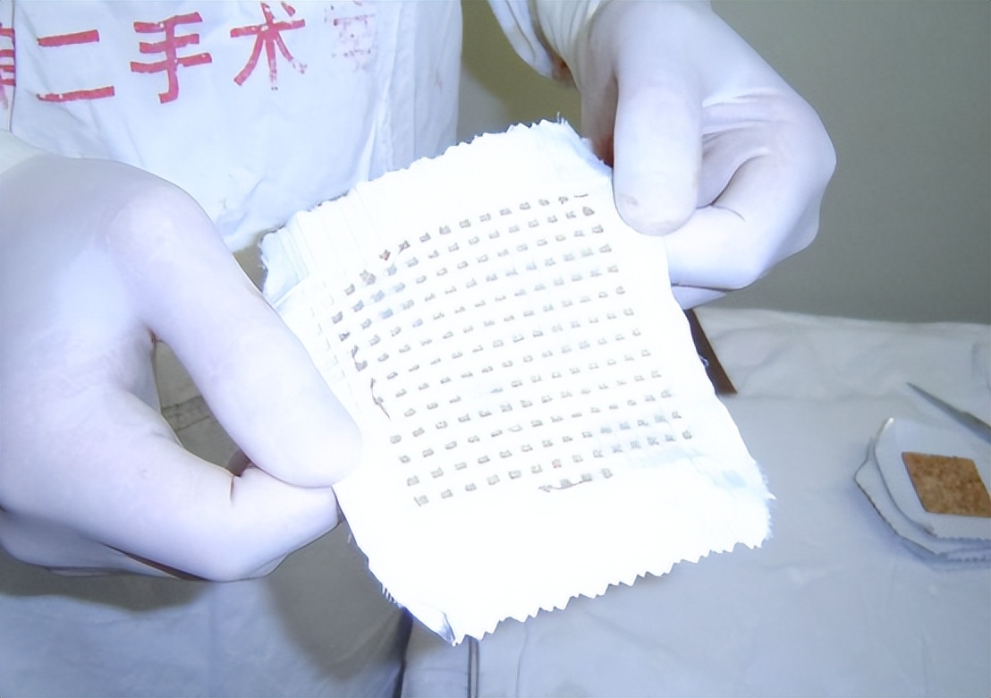 烧伤患者创面处理,烧伤创面处理的原则主要是