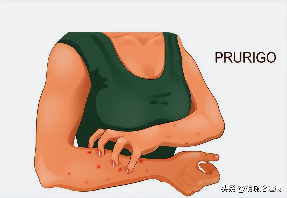 狼疮肾炎补体c4低是狼疮复发吗,狼疮性肾炎诊断的特异性抗体指标