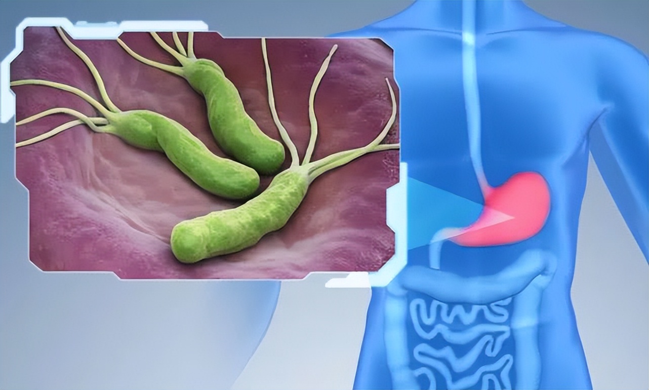 被感染了幽门螺杆菌会什么样症状,感染幽门螺杆菌症状会感觉疲乏吗