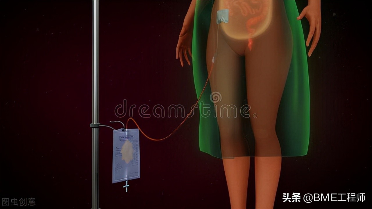 终末期肾病（尿毒症）的临床方案——人工肾脏的未来