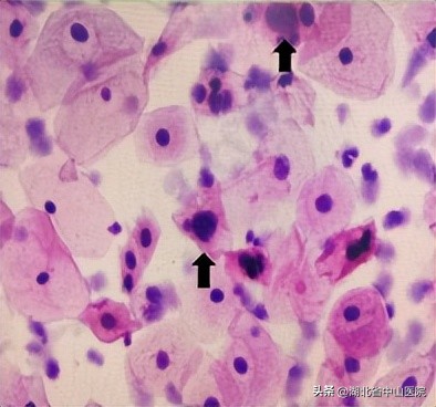 tcthpv检查都要送到病理科吗,tcthpv检查正常会得宫颈癌吗