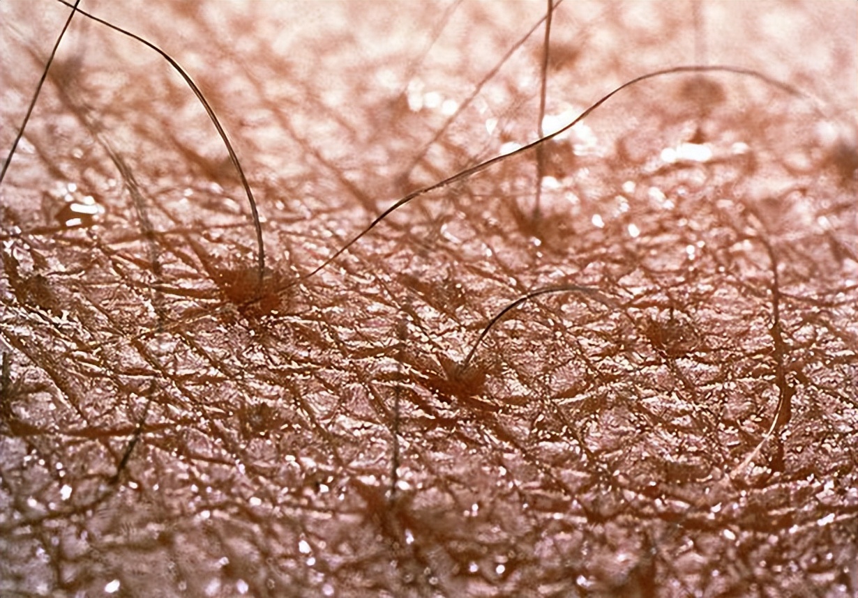 阴毛变白是身体生病了吗？