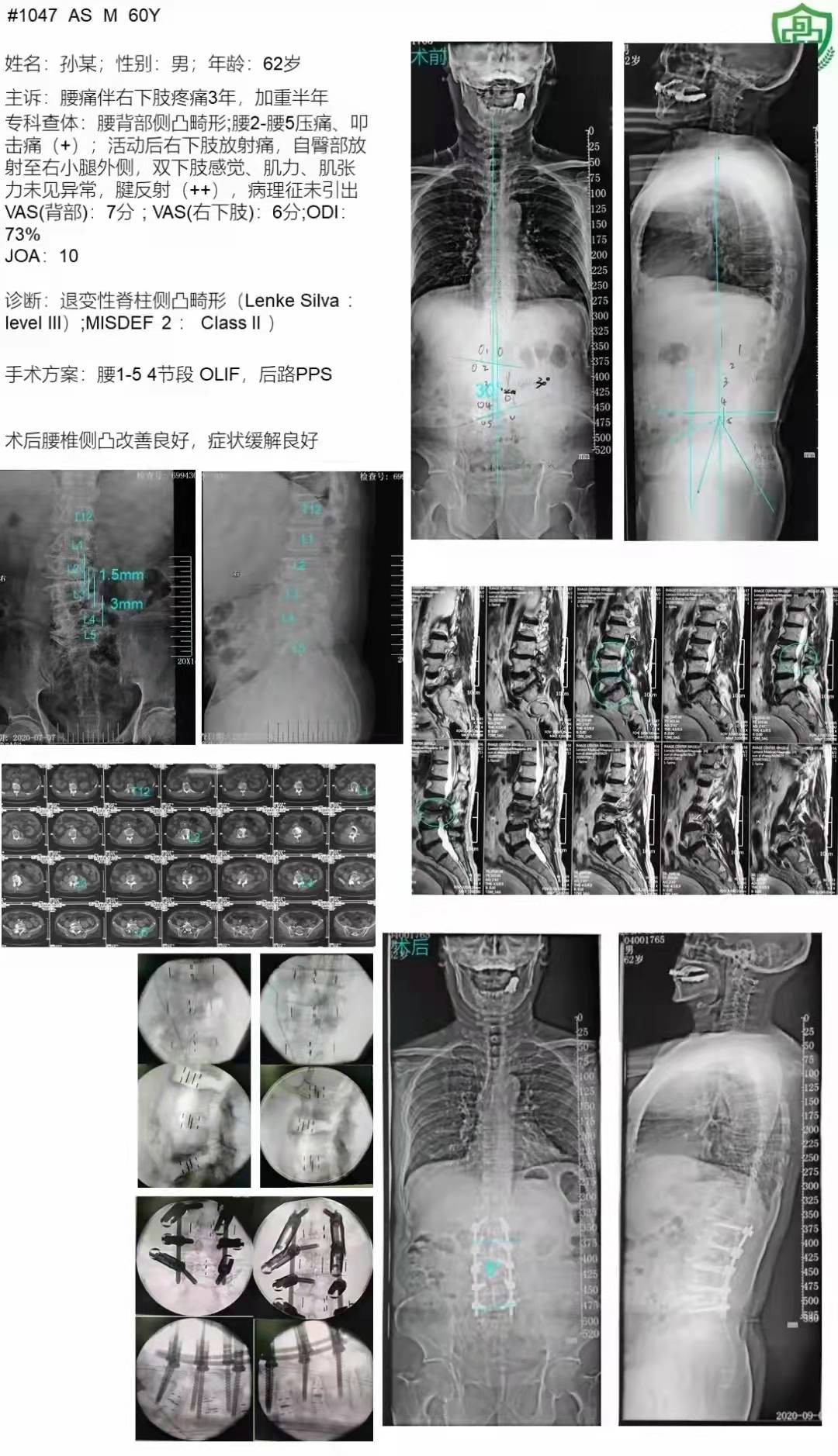 胸腰椎侧凸畸形,腰椎后凸畸形