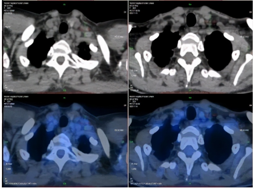 病例实录|免疫联合方案治疗胰腺癌多发转移的病例分享