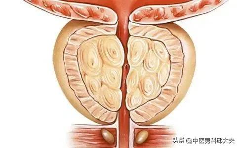 专治前列腺增生的克星中成药,前列腺增生有三种药需要都吃吗