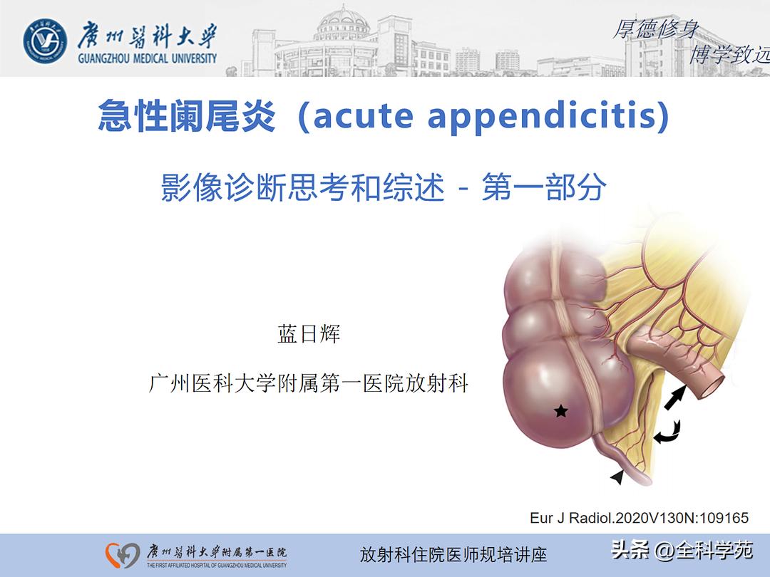 阑尾炎的讲解,关于阑尾炎的讨论总结