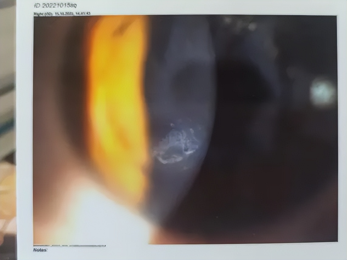 我看着手术刀往后躲，差点被医生揪着眼皮拉回去