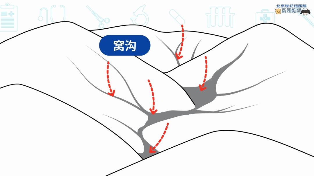 健康科普龋齿窝沟封闭,预防蛀牙科普视频