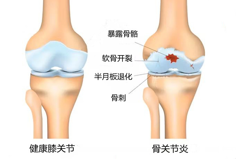 骨关节炎补氨糖的作用,骨关节炎氨糖是内服还是外敷好