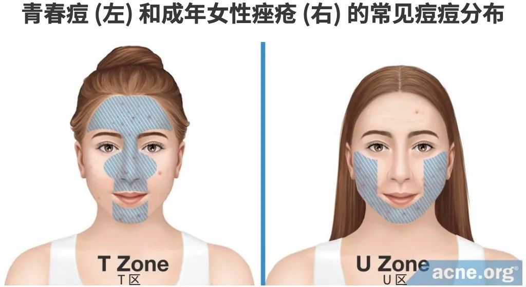 为什么二十岁开始疯狂长痘,一个人反反复复长痘什么原因