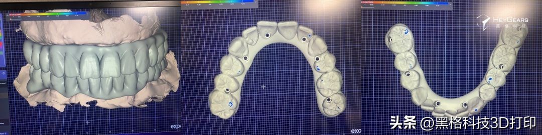 病例分享|美国BDG诊所实现全口即刻修复病例一则