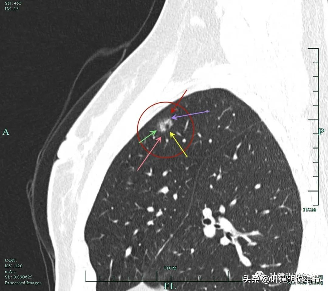 磨玻璃结节伴有增生是癌症吗,磨玻璃结节会是别的癌转移的吗