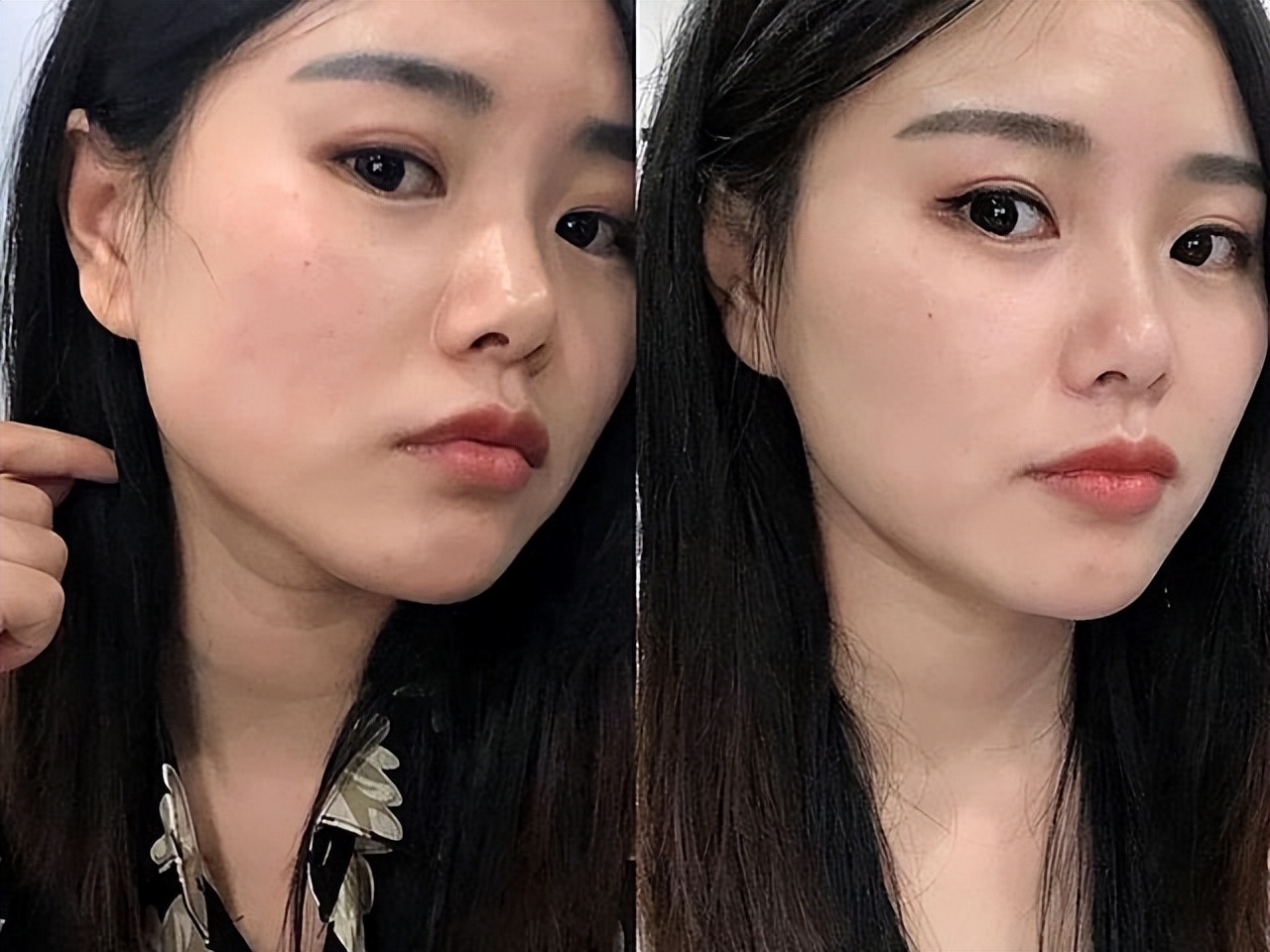 咬肌大反复打瘦脸针还是一直大,打瘦脸针第三天咬肌仍然有力