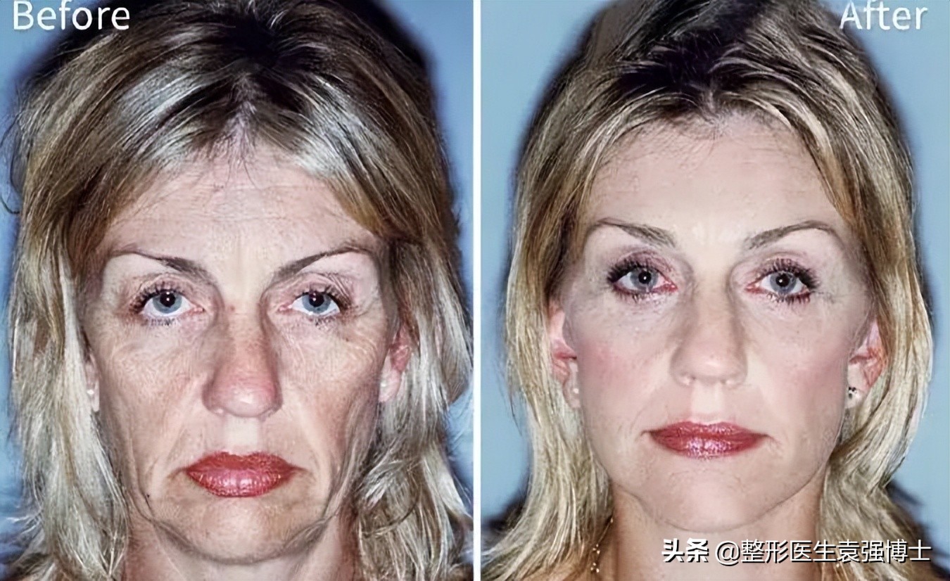 40岁后面部抗衰，填充、光电、线雕、拉皮哪个更靠谱？,医生总结