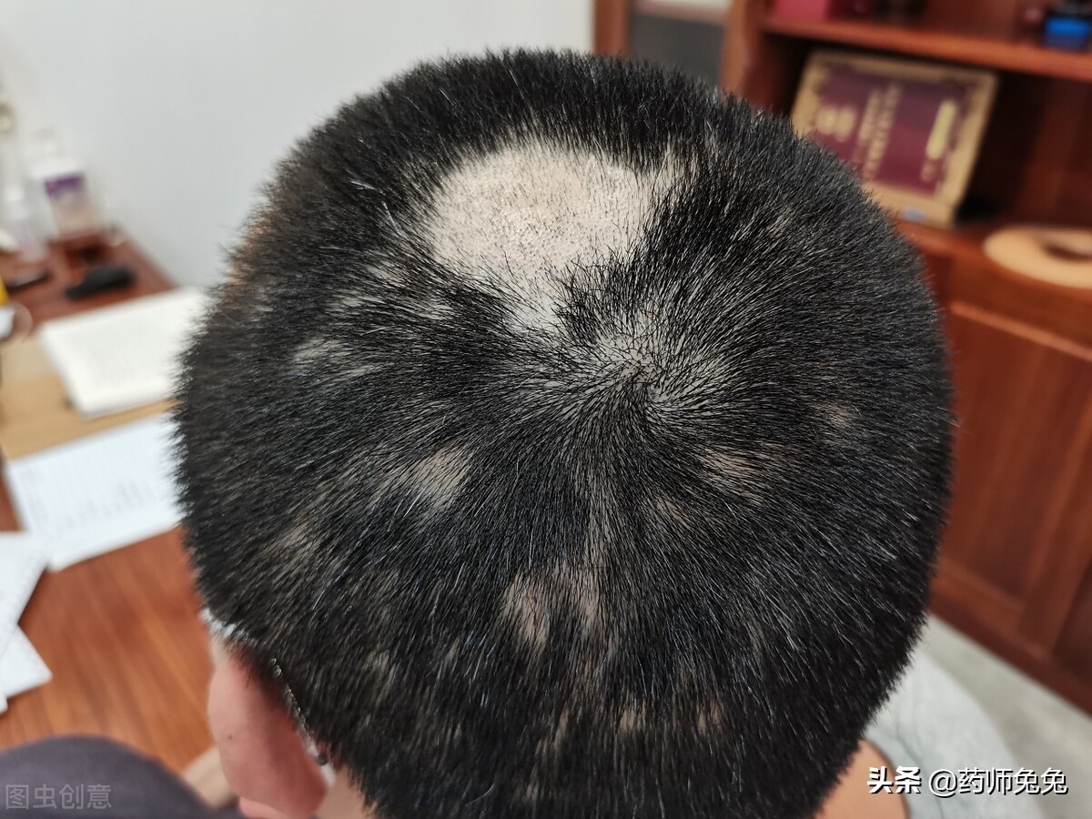 斑秃为什么叫鬼剃头啊,斑秃又被称作为鬼剃头
