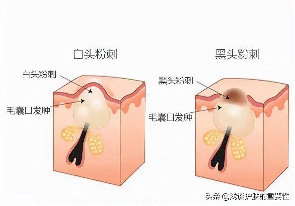 鼻子出油后补妆草莓鼻特明显,油性皮肤草莓鼻怎么改善
