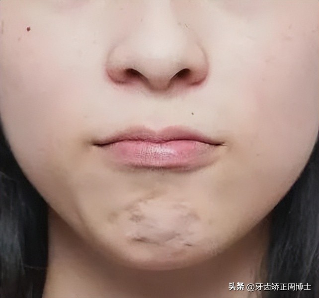 闭嘴巴下巴有核桃纹做什么手术,为什么下巴会有像核桃一样的纹路