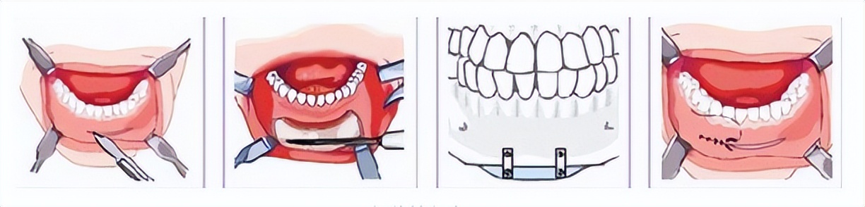 侧颜下巴后缩,明星下巴后缩侧颜