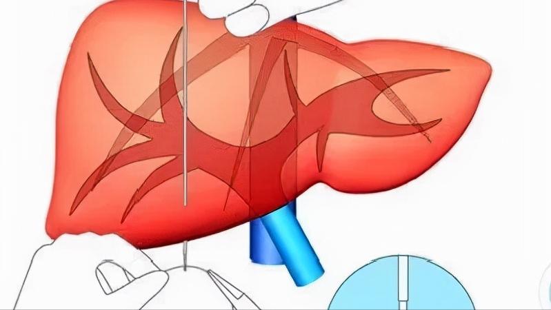 谷丙转氨酶高怎么回事是什么病,谷丙转氨酶高怎么回事严重吗