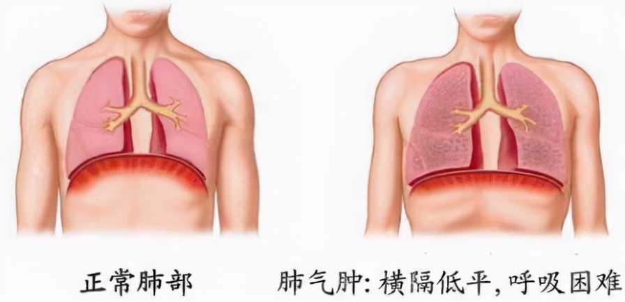 肺气肿如何食疗,中医肺气肿治疗最佳方法