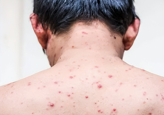 艾滋病不是病,有艾滋病的所有症状又是艾滋病吗