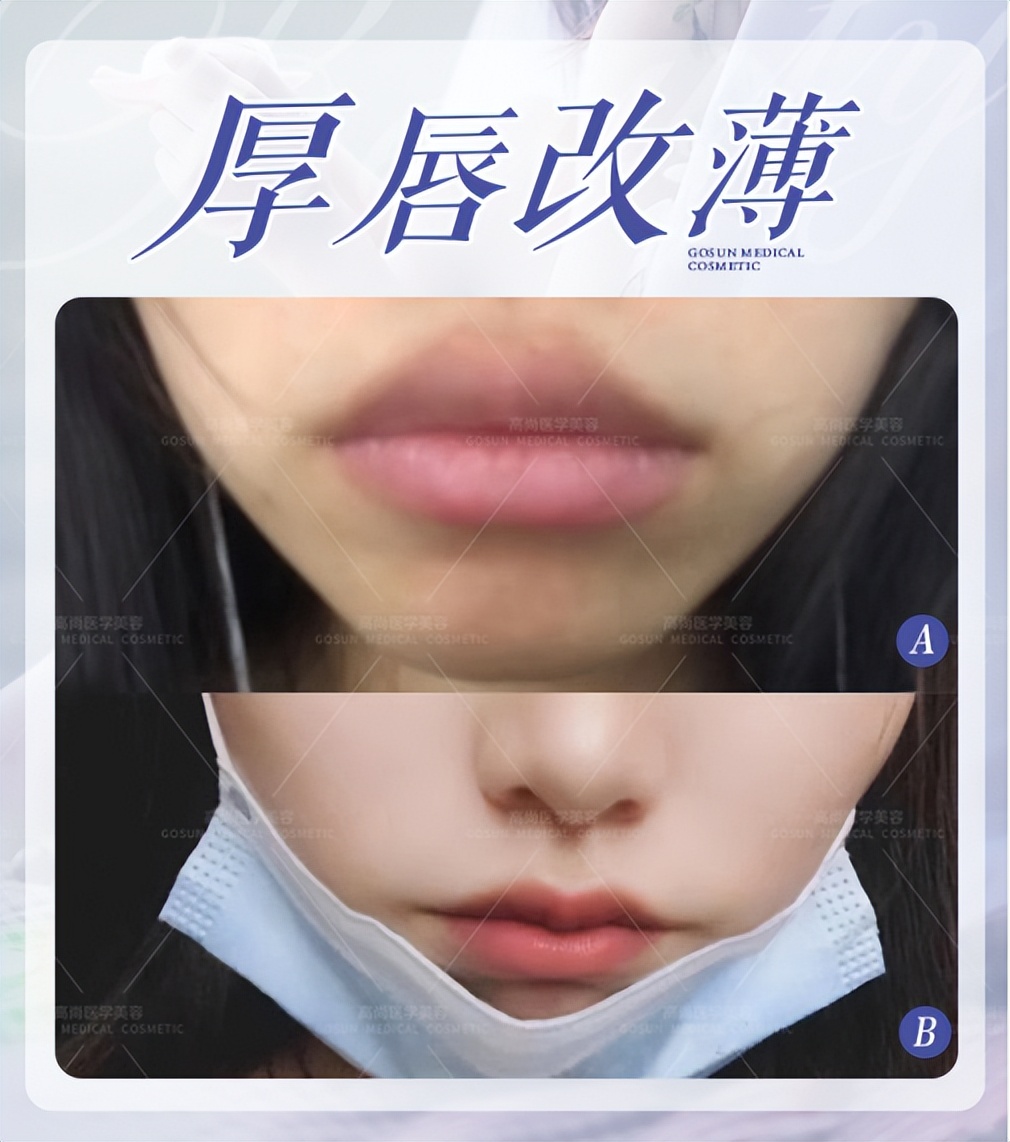 嘴唇厚其实有很多烦恼,嘴唇厚的女生有什么特点