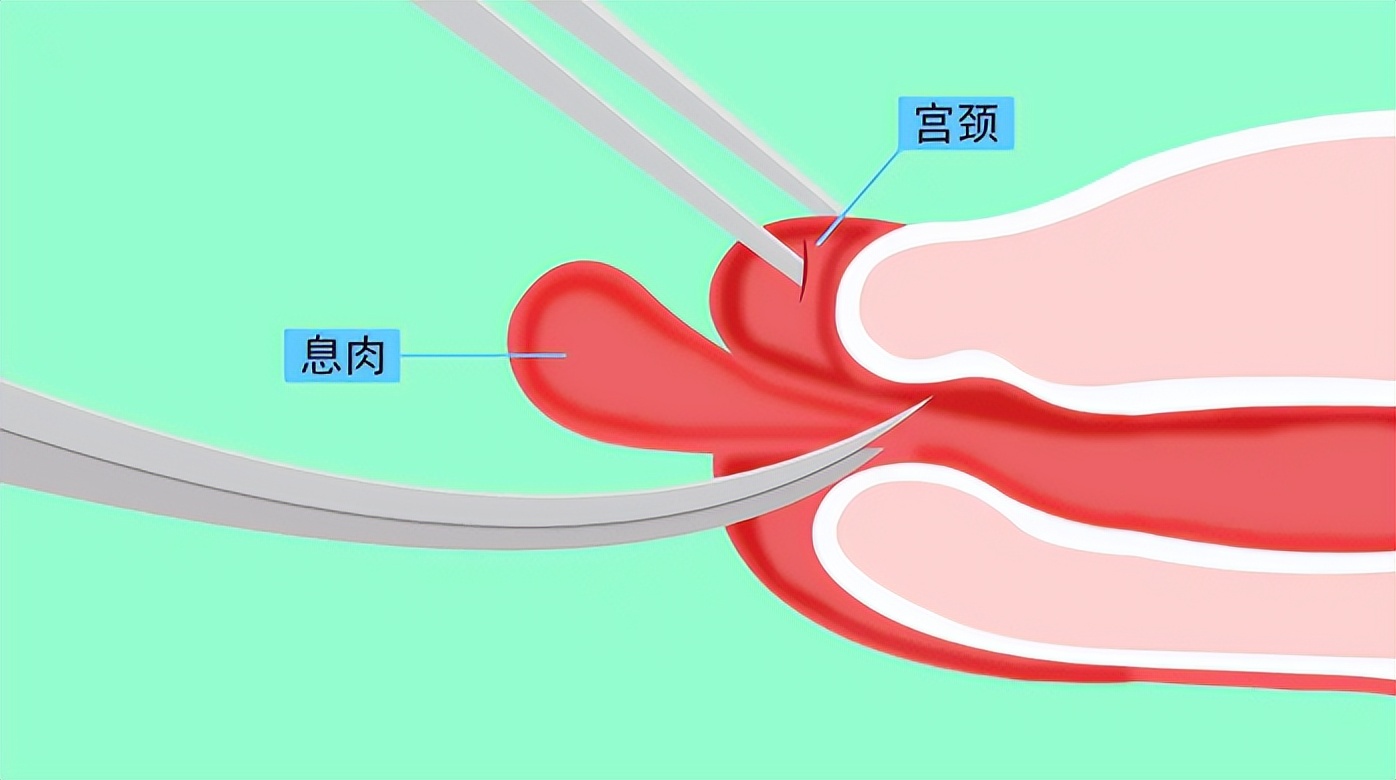 宫颈息肉吃什么好得快,宫颈息肉手术后吃什么食物恢复