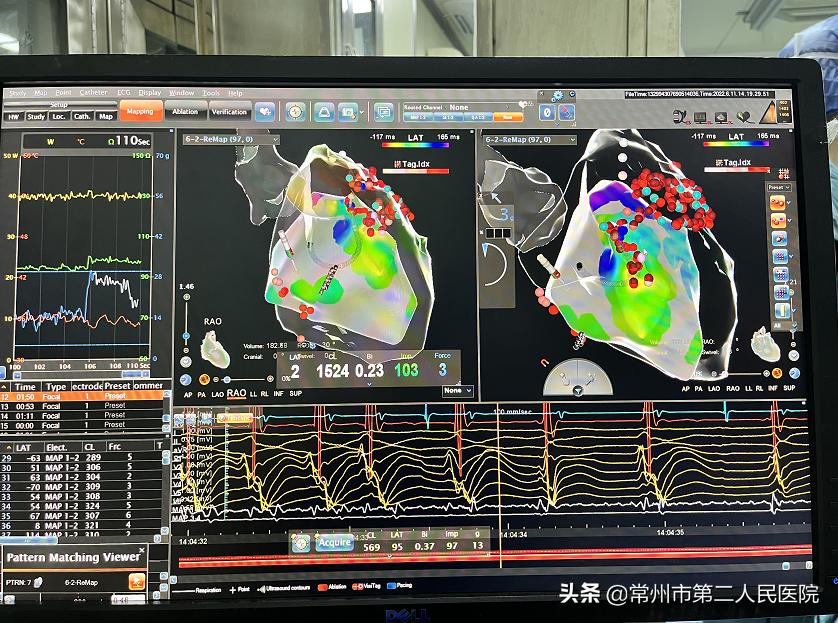 常州二院心内科团队完成省内首例ECMO支持下室速电风暴射频消融
