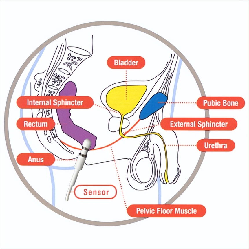 阴部神经电针刺激联合盆底肌锻炼治疗前列腺癌术后尿*禁失**