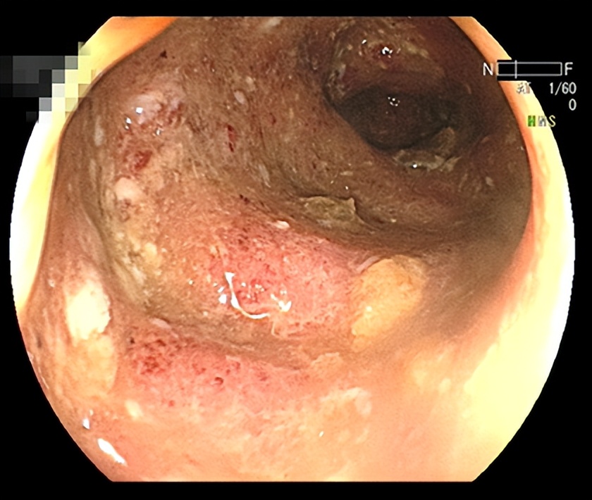 20多岁年轻姑娘，她的肠道竟然是这样的……