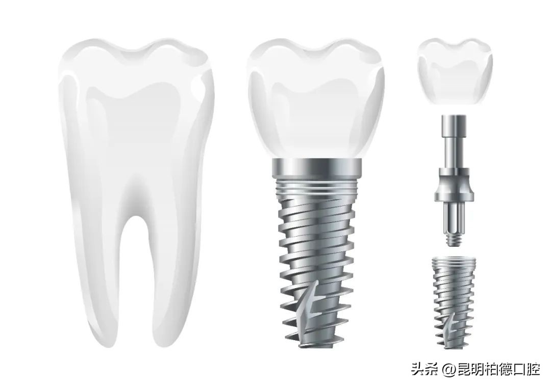 如何合理的选择种植系统,种植体德国