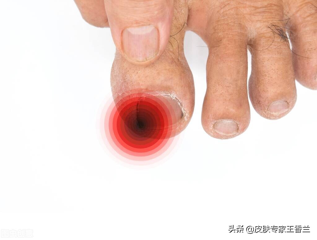 指甲长进肉一碰就疼,指甲长进肉里特别深