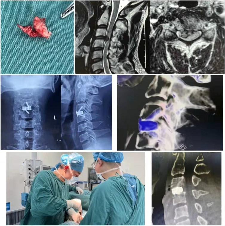 当夜跑爱好者遇上“颈椎病”：颈椎微创手术后多久可以恢复正常？