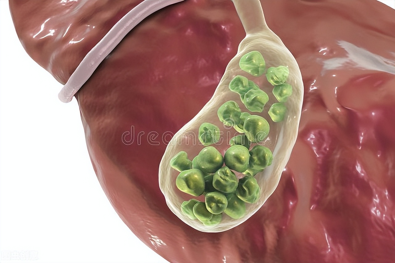 胆结石腹部持续性疼中药调理方,胆结石上腹疼吃什么药