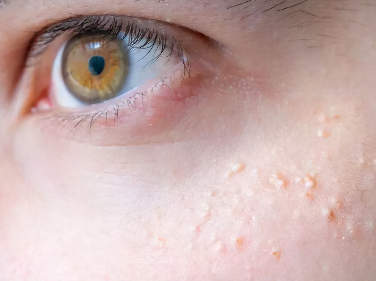 脂肪粒和闭口长什么样,脂肪粒闭口长啥样的