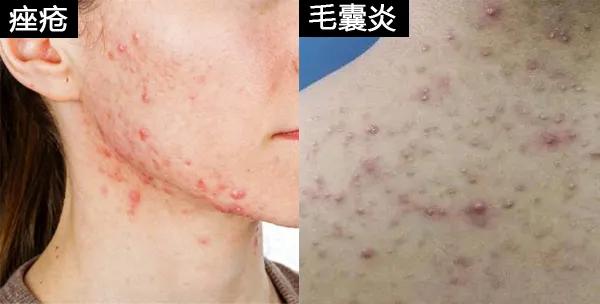 疮和疖子怎么区分,毛囊炎和须疮的区别