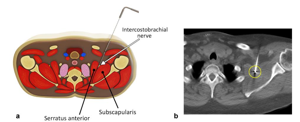 介入科治疗乳腺癌,介入疗法治疗乳腺癌
